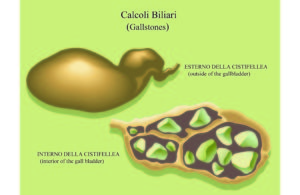 obesità calcoli biliari e chirurgia bariatrica